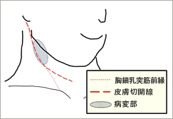 頸 動脈 圧迫