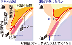 頭痛 肩こりとまぶたのたるみ 眼瞼下垂 社会医療法人蘇西厚生会 松波総合病院