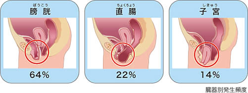 中高年女性に多い 骨盤臓器脱 社会医療法人蘇西厚生会 松波総合病院