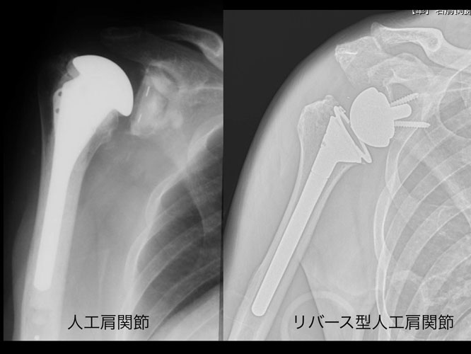 反転型（もしくは逆型）人工肩関節置換術（リバース型人工肩関節置換術 ...